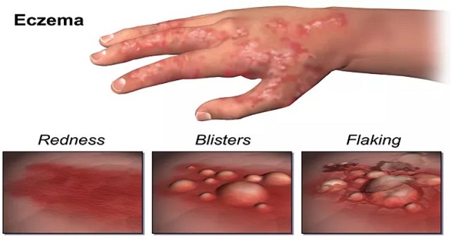 How to stop eczema itch